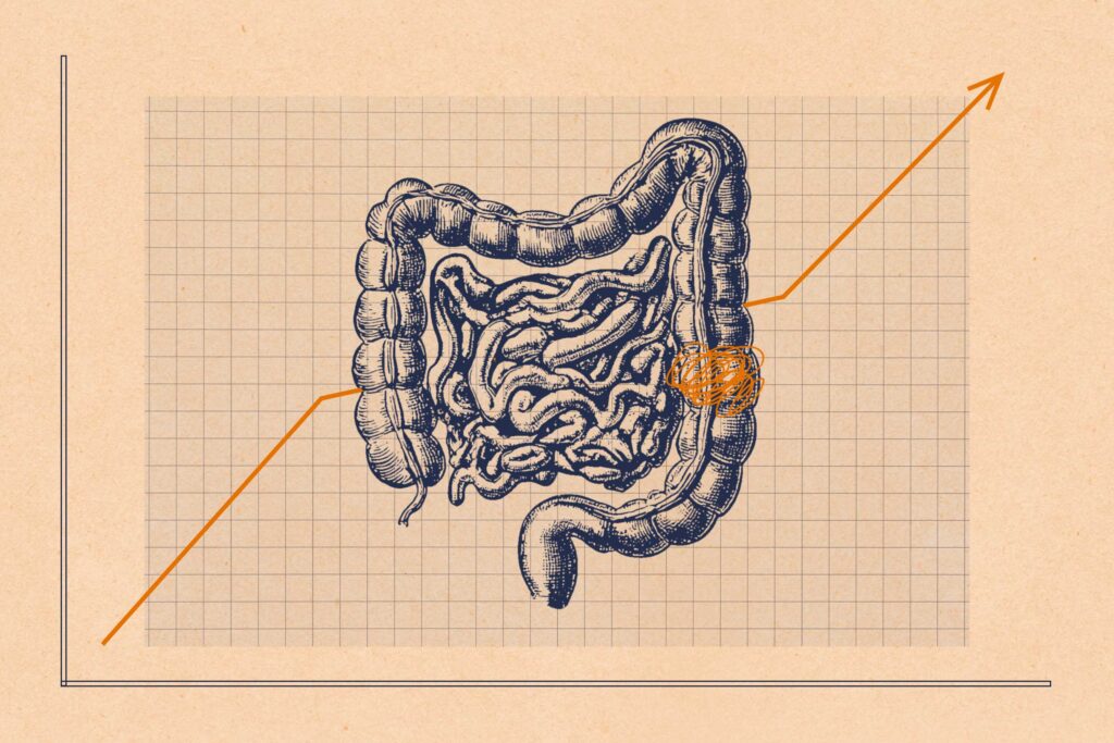 Colorectal cancer now leading cause of cancer deaths under age 50
