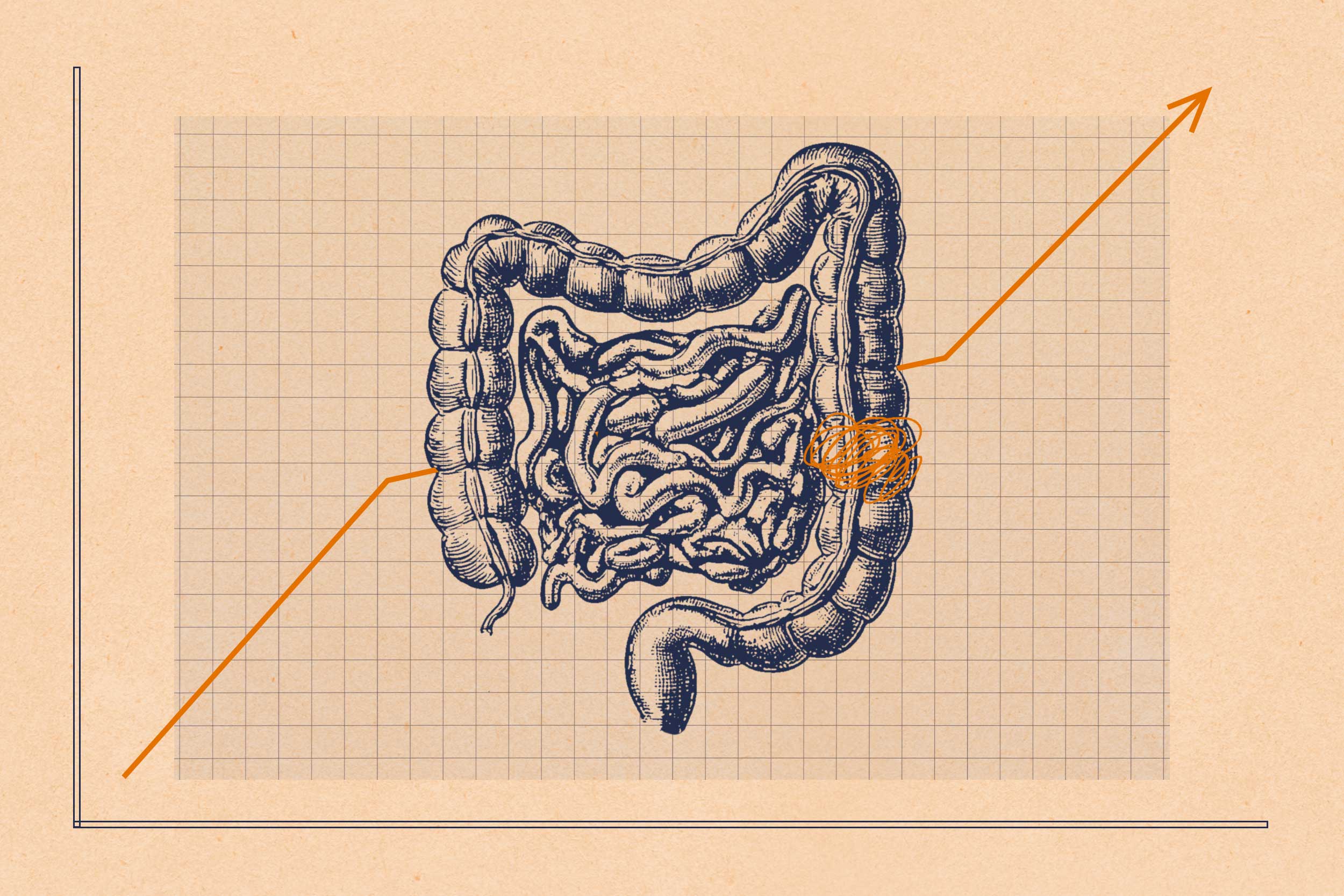 Colorectal cancer now leading cause of cancer deaths under age 50