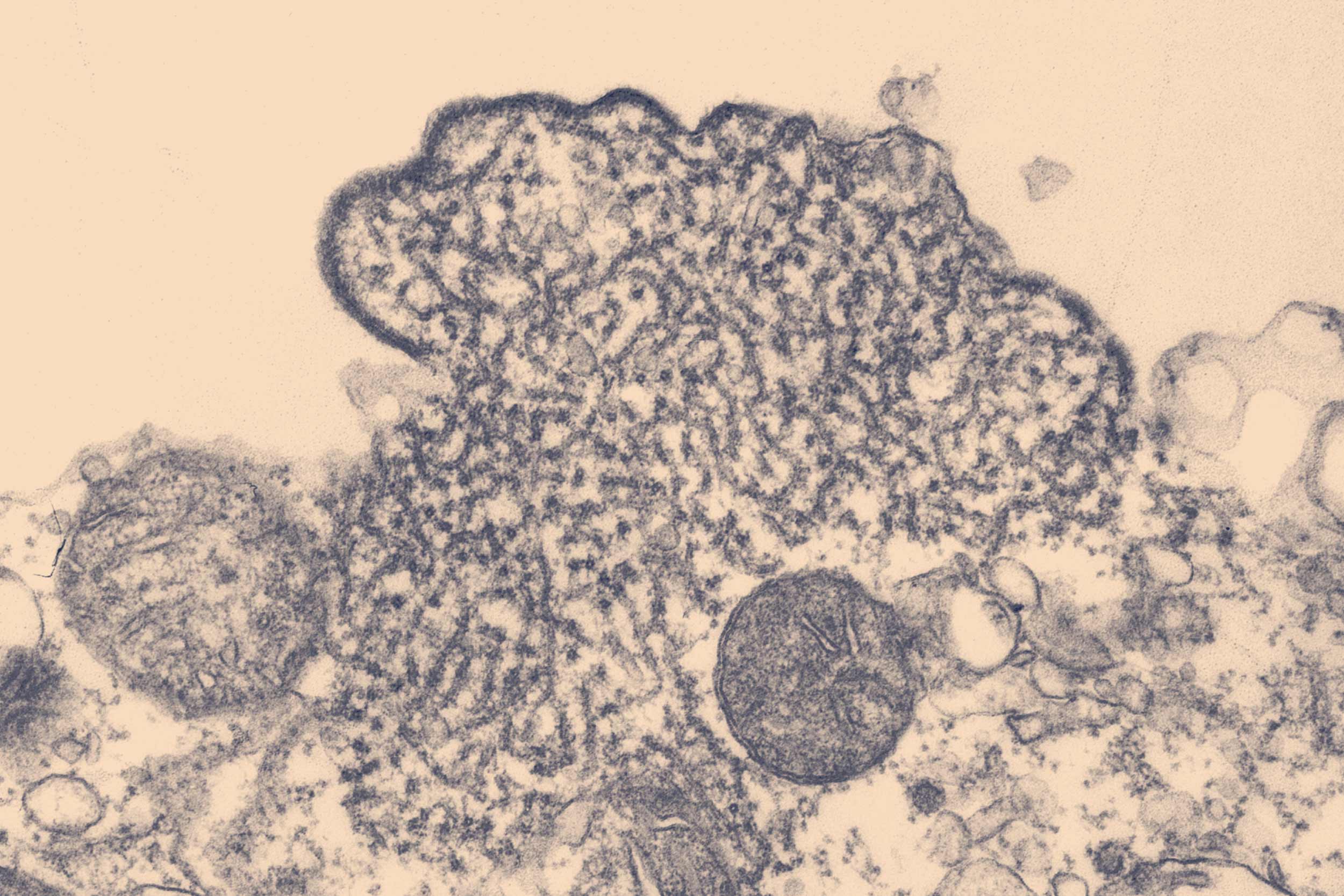 Nipah Virus Contained: No Vaccine, High Fatality, Global Precautions