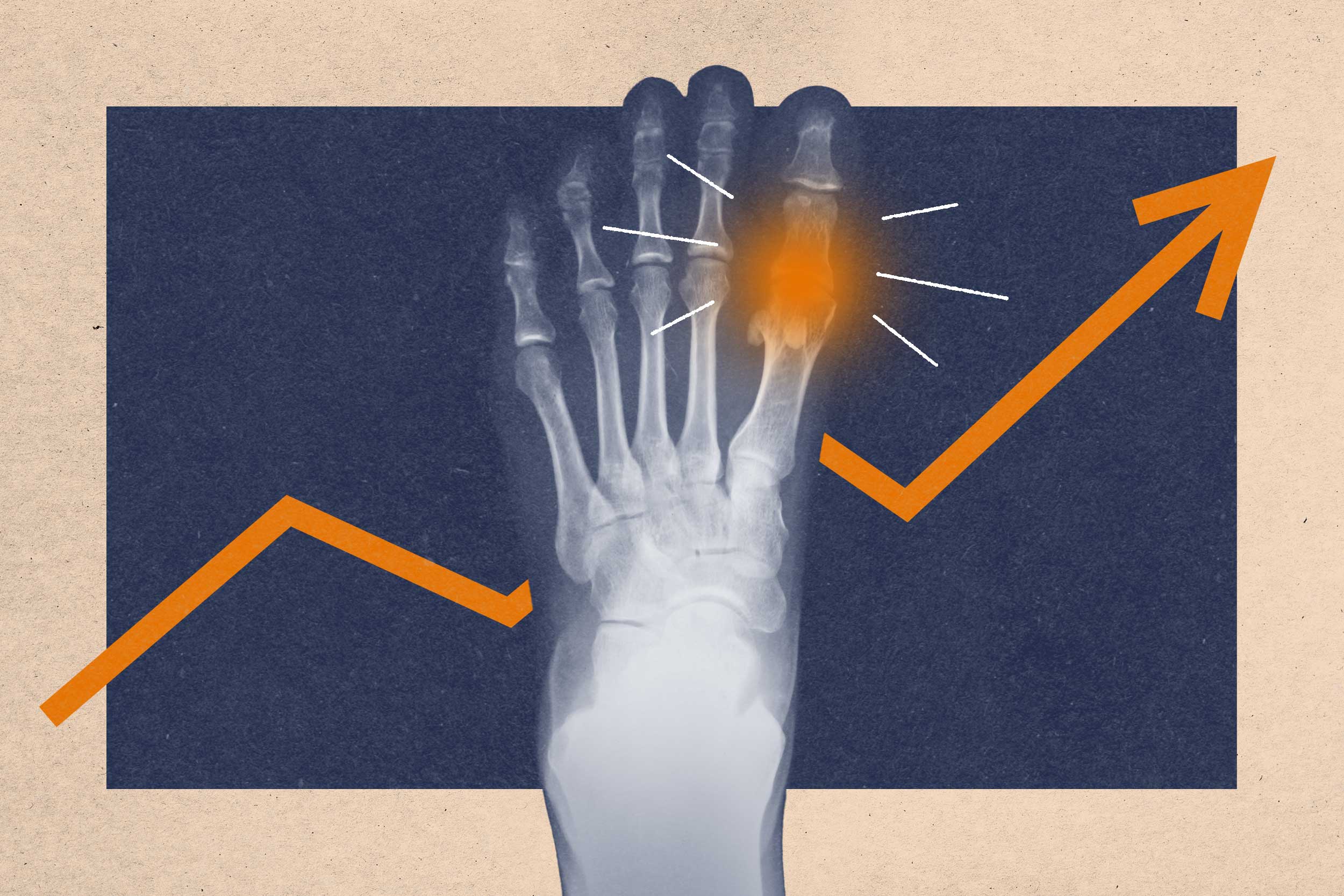 Gout: From Royal Affliction to Widespread Health Concern