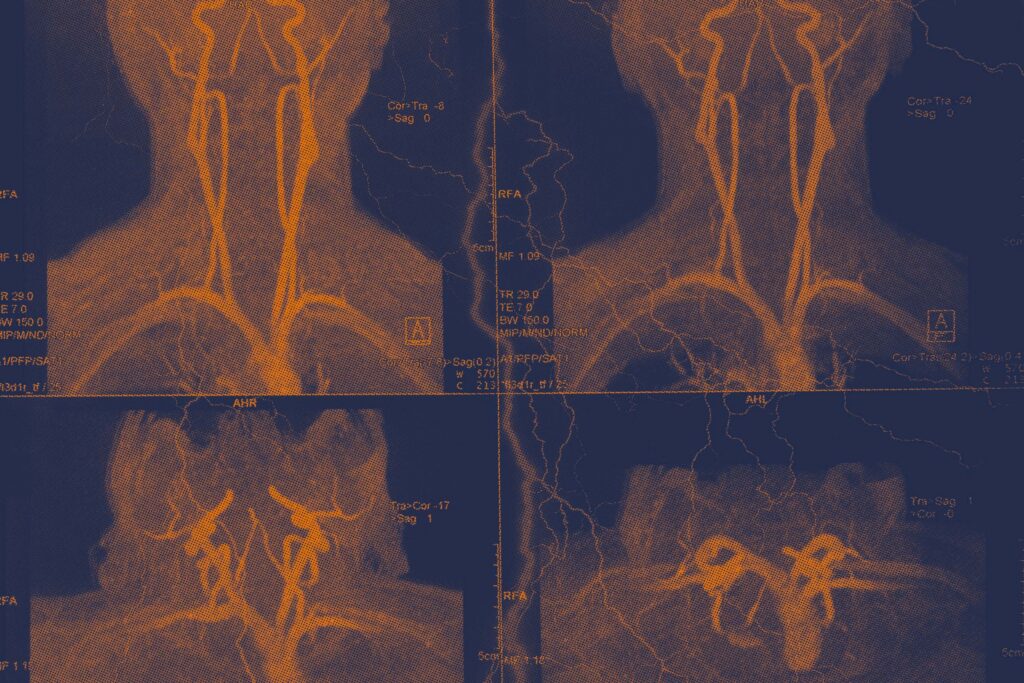 Gene Differences Found in Younger Stroke Patients by UVA Researchers