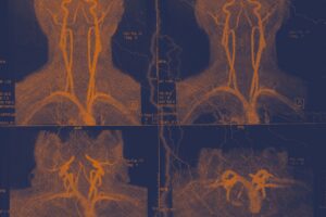 Gene Differences Found in Younger Stroke Patients by UVA Researchers